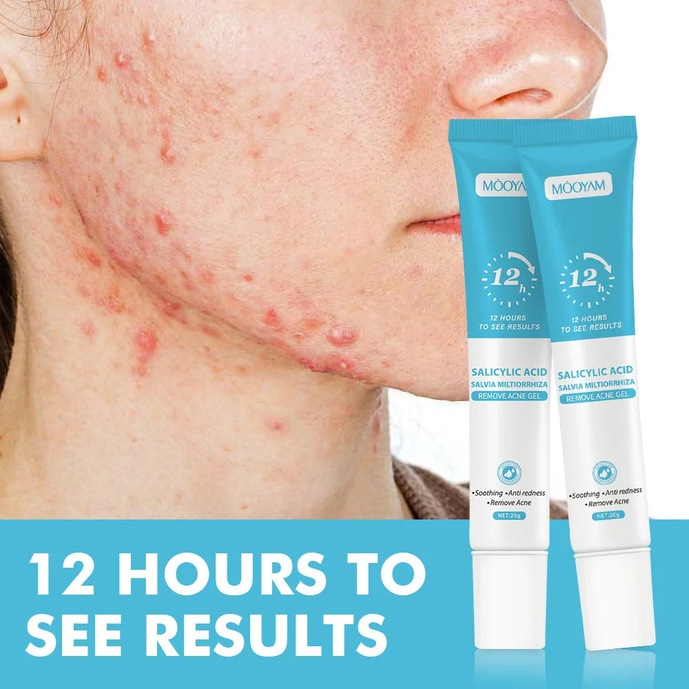 Gel Anti-Acné de Acción Rápida con Ácido Salicílico (20g)
