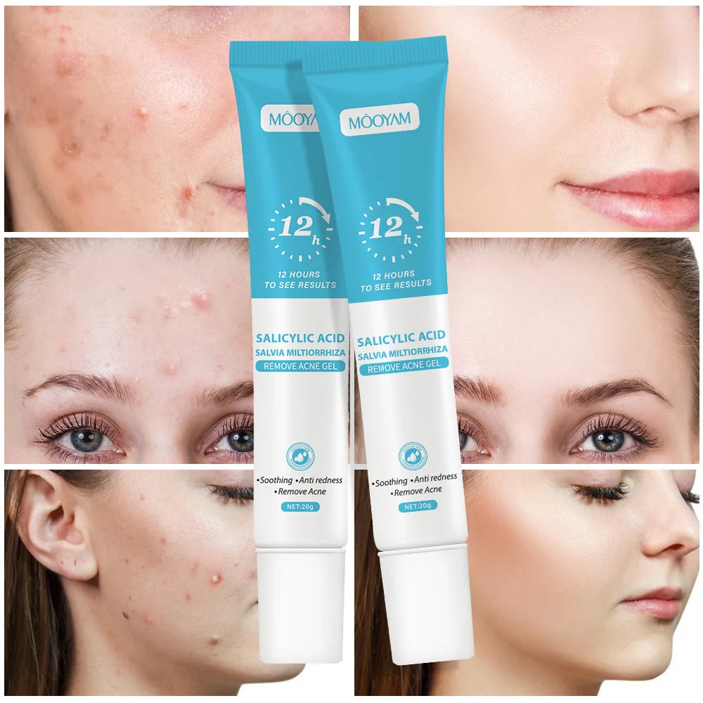 Gel Anti-Acné de Acción Rápida con Ácido Salicílico (20g)